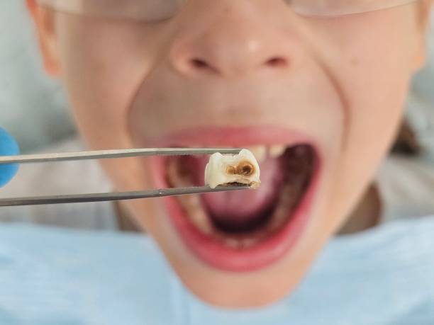 Best Emergency Dental Care for Abscessed Tooth in Harper Woods, MI